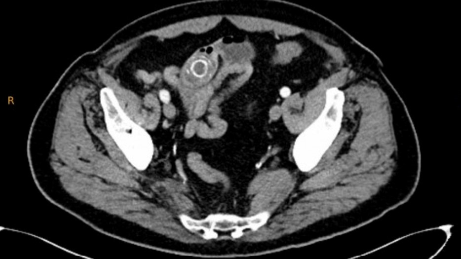 IiS_gallstone_1CT A 2.png