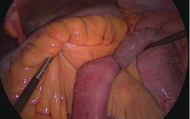 Internalhernia_figure3a.jpg