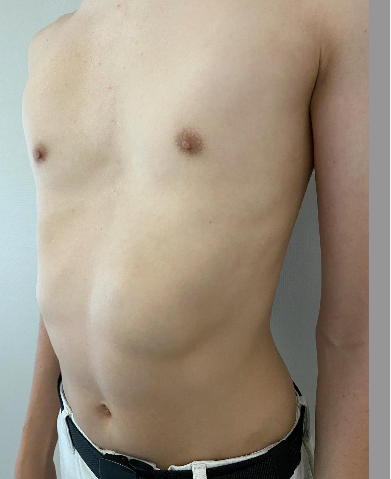 Trichterbrust_Figure 3b.png