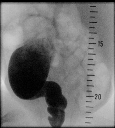 Hirschsprung_Fig.2.jpg