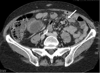 Internalhernia_Figure 2a_BSCH.jpg