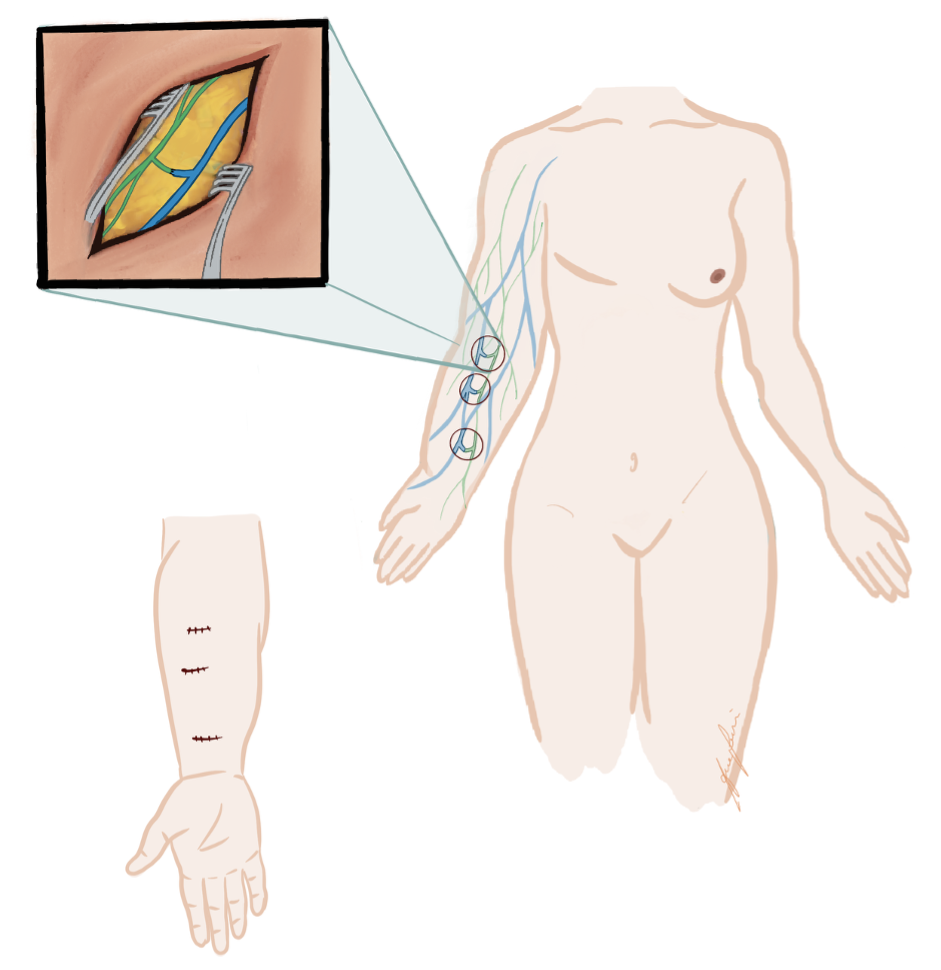 Lymph_Figure3.png