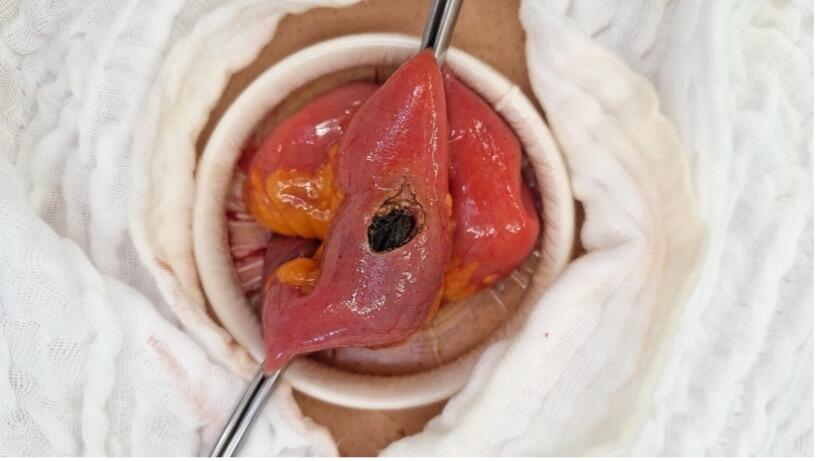 Iis_gallstone_color.jpg