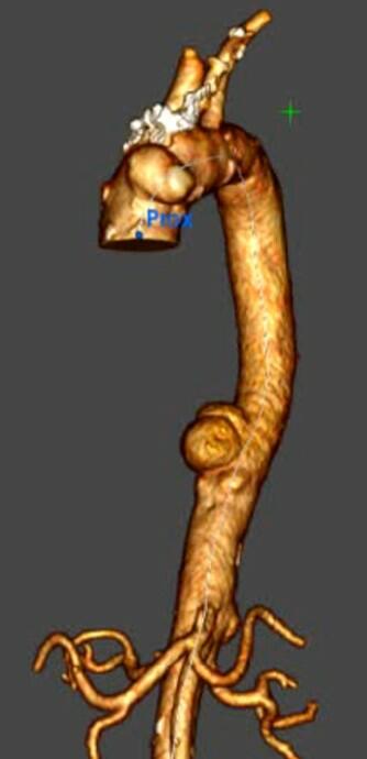 pöll_1-3D Darstellung der mykotischen Aneurysmata.jpg