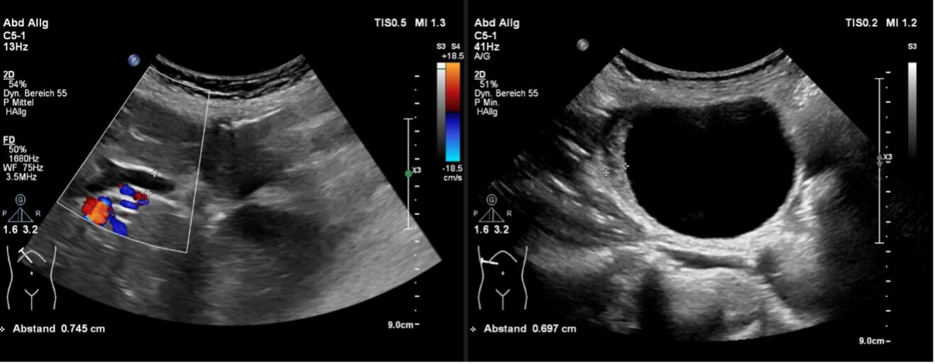 Iis_gallbladder_A.jpg