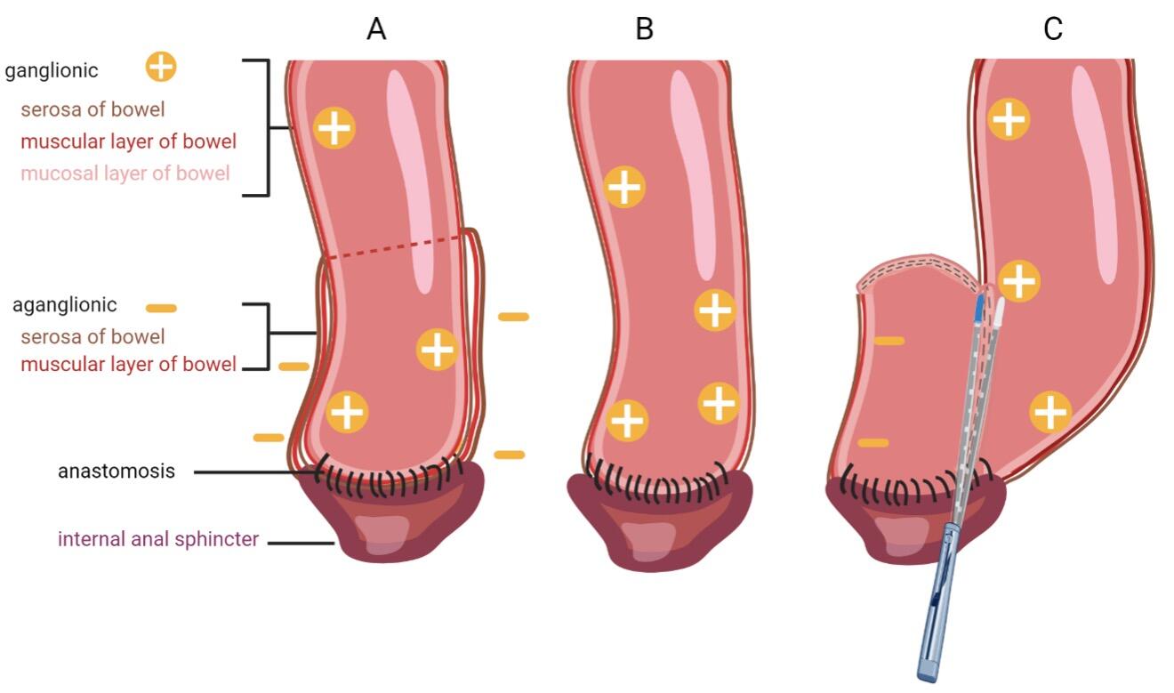 Hirschsprung_Fig.3.jpg