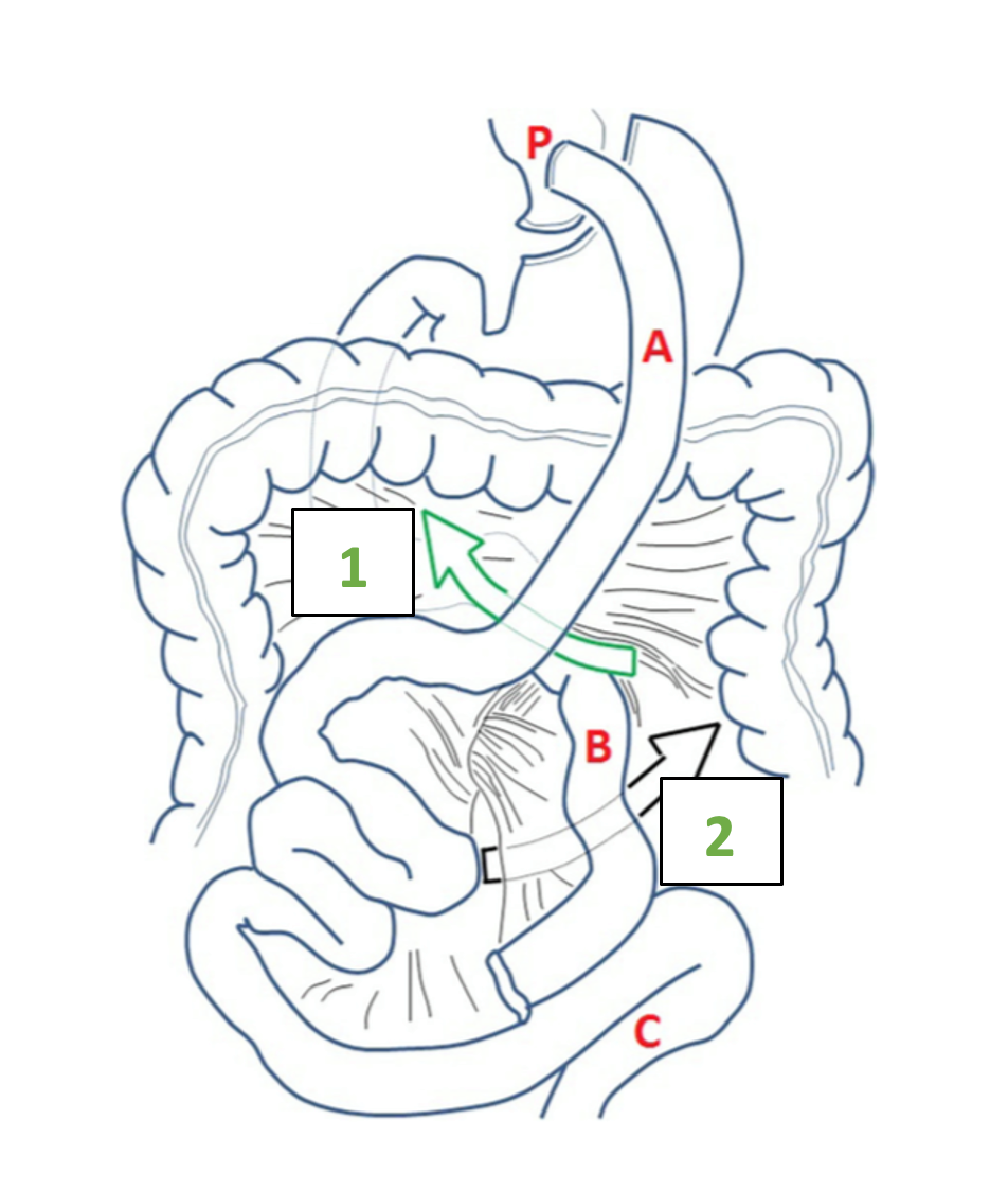 Internalhernia_Figure1_neu.png