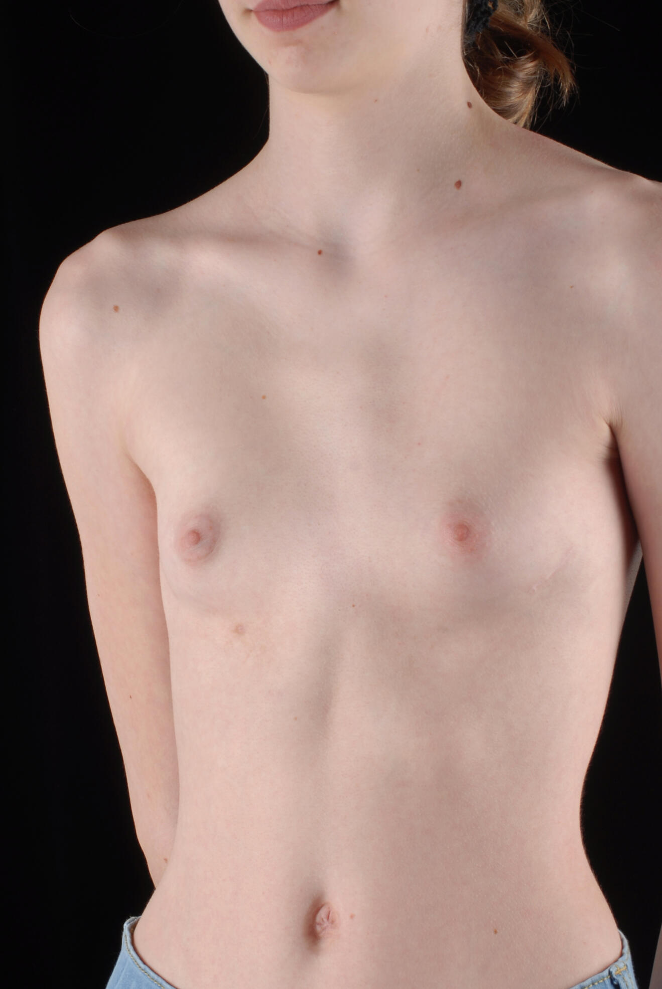 Trichterbrus_Figure 2b 13y old female after MIRPE.jpg