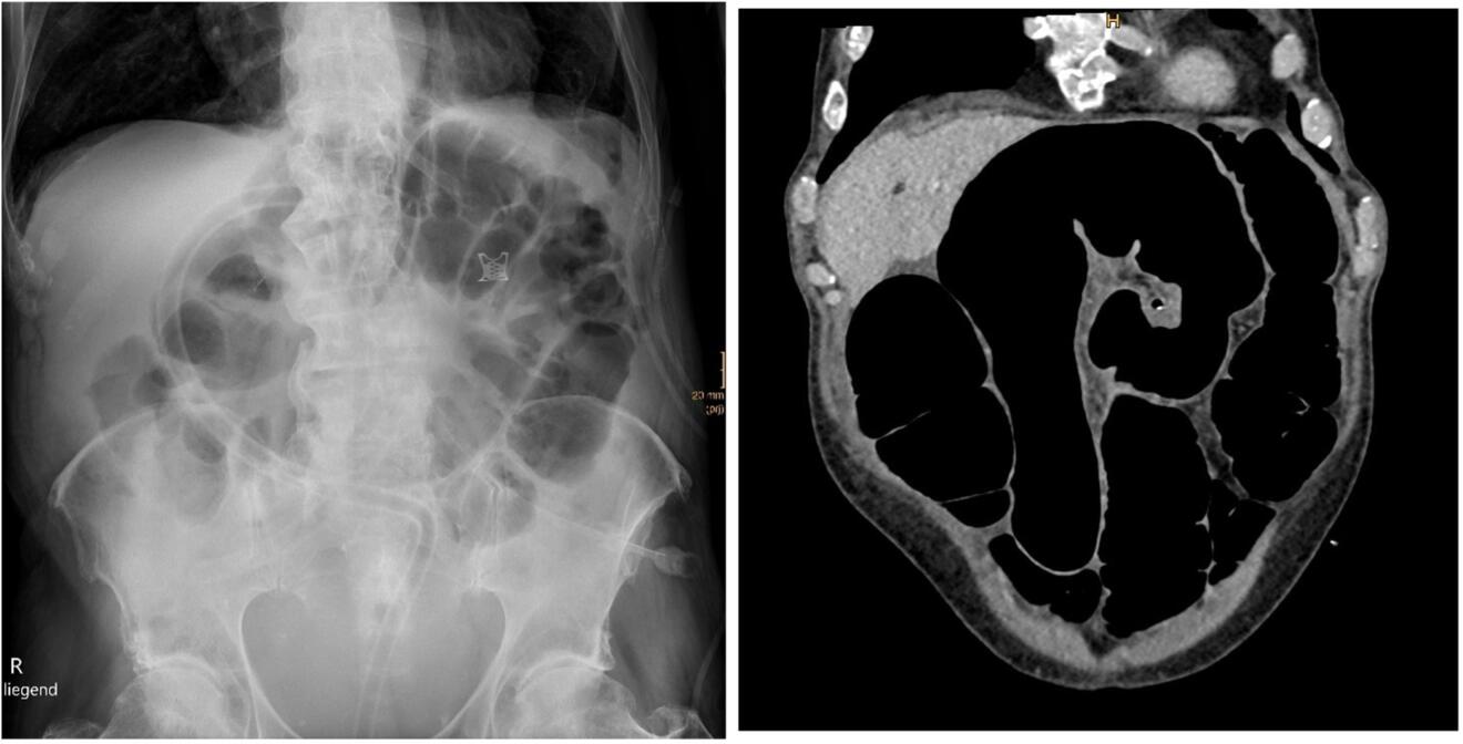 IiS_sigmoidectomy_Fig.1.jpg