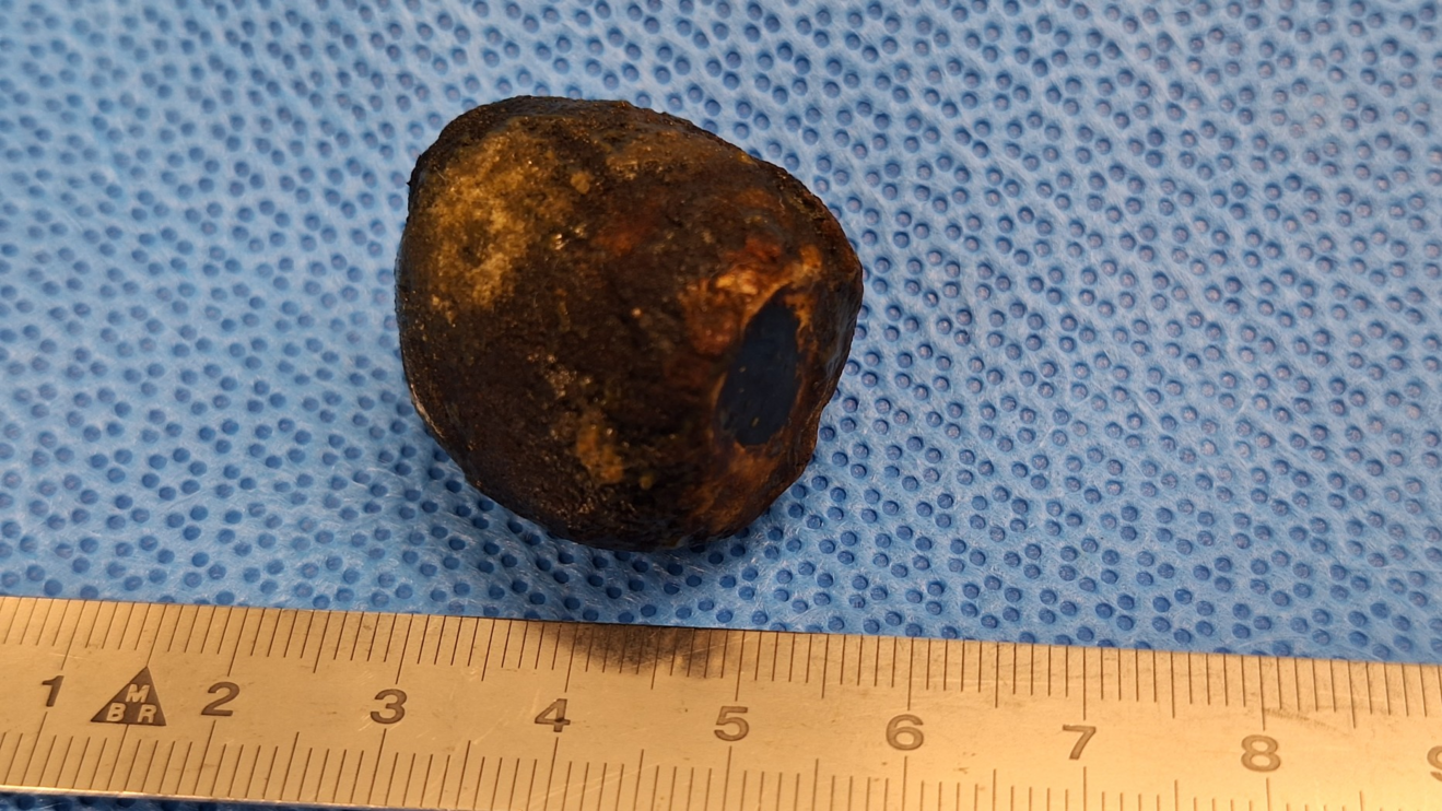 IiS_Gallstoneileus.png