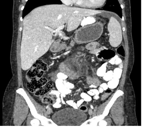 Internalhernia_Figure2b.jpg