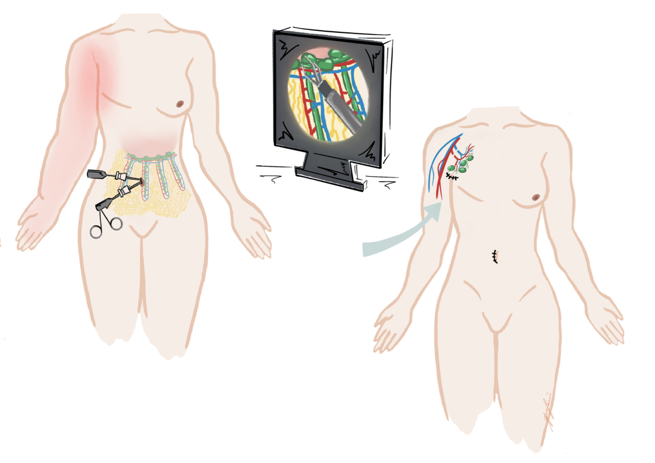 Lymph_Figure5.png
