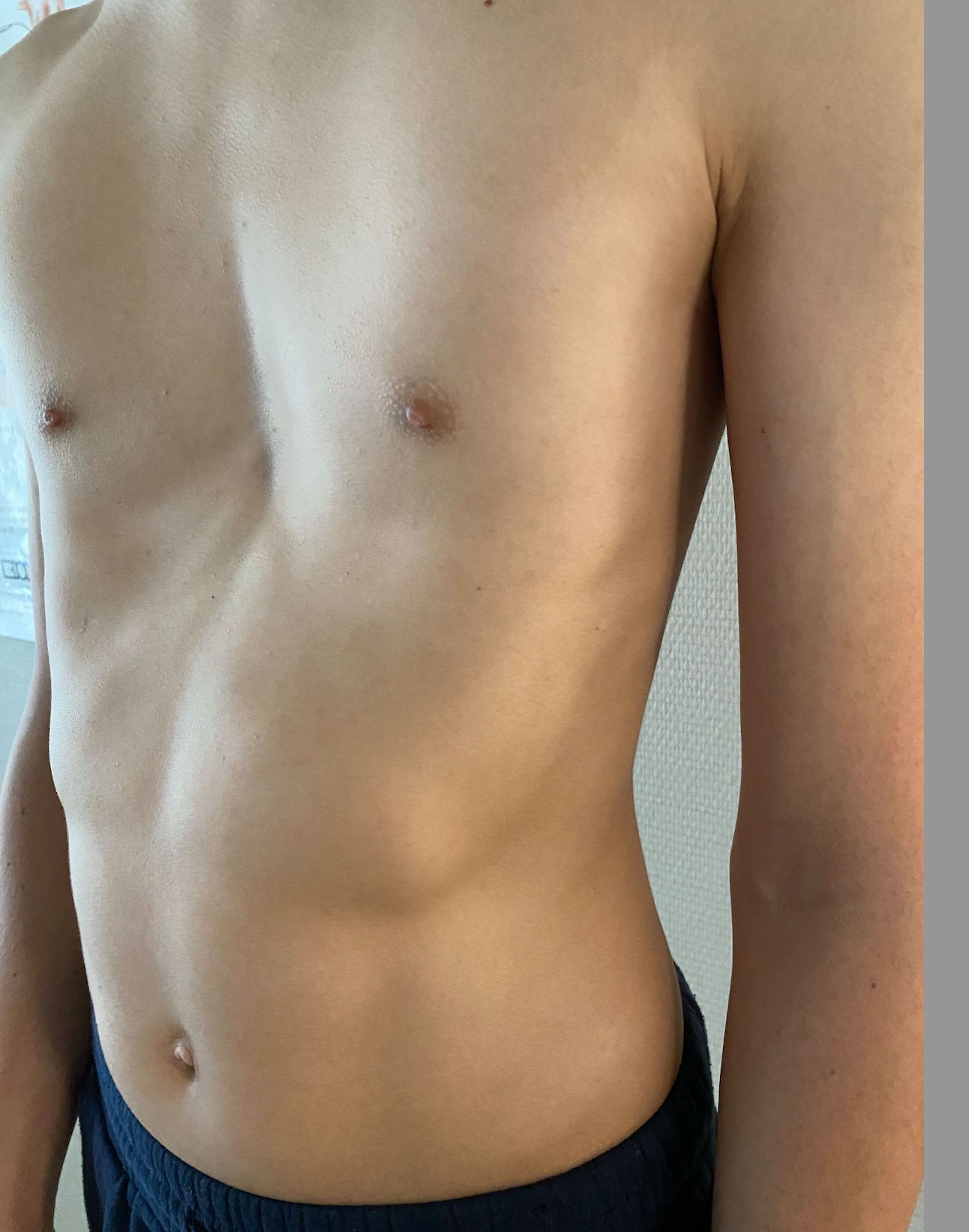 Trichterbrust_Figure 3a.png