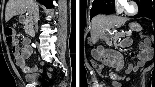 IiS_gallstone_CT b.png
