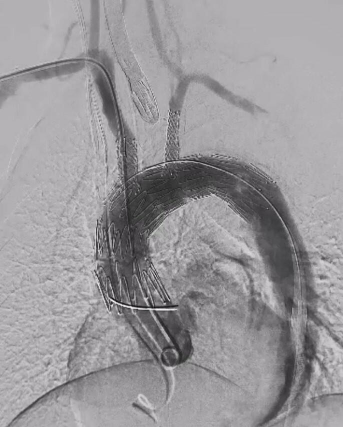 pöll_3-Intraoperative Angiographie.jpg