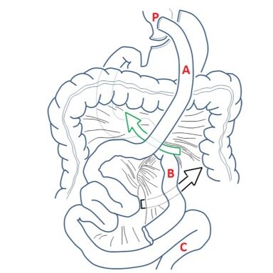 Acute Abdominal Pain after Roux-en-Y Gastric Bypass