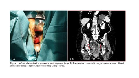 A vaginal prolapse – not necessarily a gynecological problem