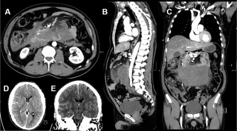 Dinner table syncope, epigastric pain and intracranial hemorrhage unveils the hidden danger