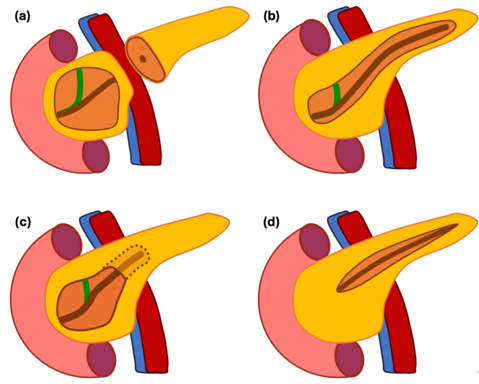 Robotische Duodenum-erhaltende Pankreaskopfresektion