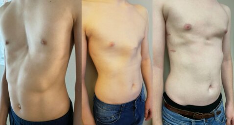 Old habits and new trends for effective treatment of chest wall deformities