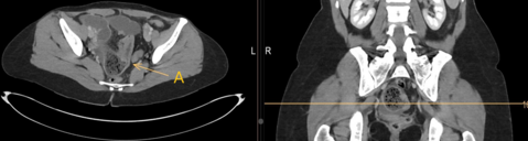 Persistent Abdominal Pain and Vomiting