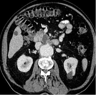 Aortic Puzzles: A Patient’s Journey