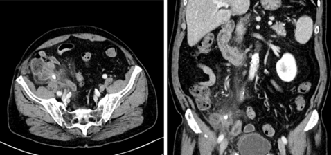 When appendectomy is not the end of it