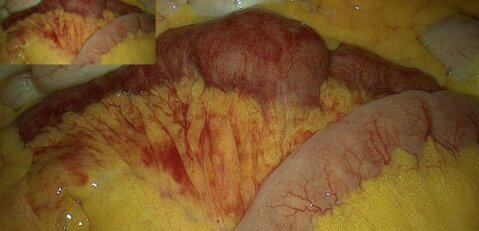 Spontaneous Mesenteric Venous Thrombosis in a Young Patient Without Identifiable Predisposition