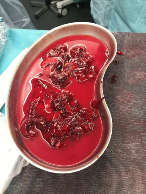 Benefits of Patient Blood Management