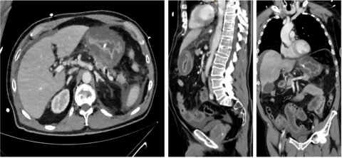 Upper endoscopy with unusual consequences