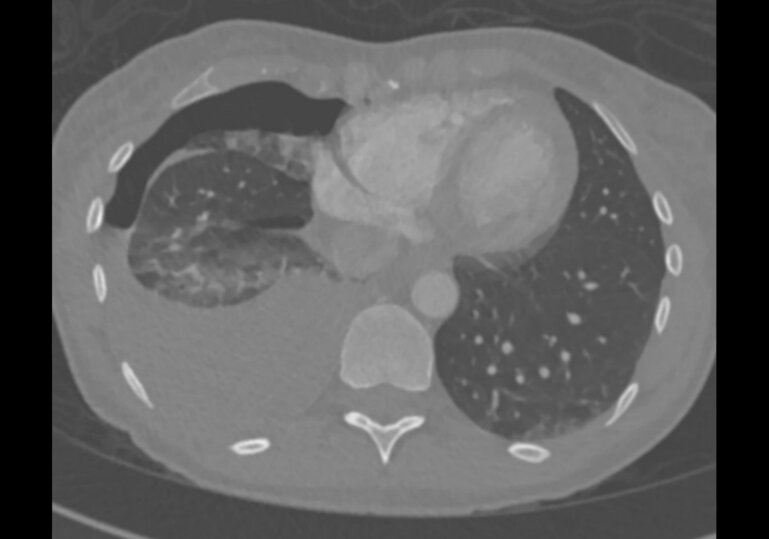 The unusual thoracic suspect